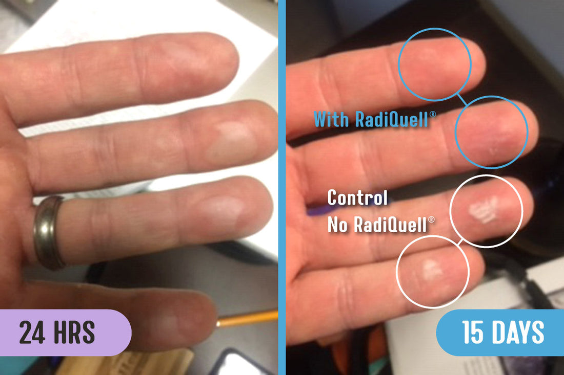 Before and after comparison showing burn blisters on a person's fingertips at 24-hours and 15-day post burn. The after photo highlights improved healing results of two fingers treated with RadiQuell® compared to two fingers without 