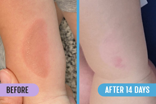 Before and after comparison of a burn on a toddler's arm, with the left image showing the initial burn and the right showing it healed after 14 days of treatment with RadiQuell®