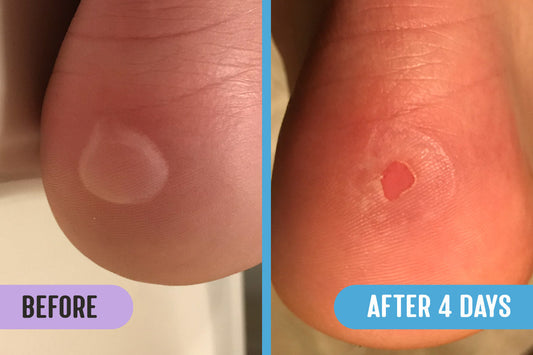 Before and after comparison of a 0.75-inch fluid blister on a person's heel, with significant improvement after treatment with RadiQuell® for 4 days