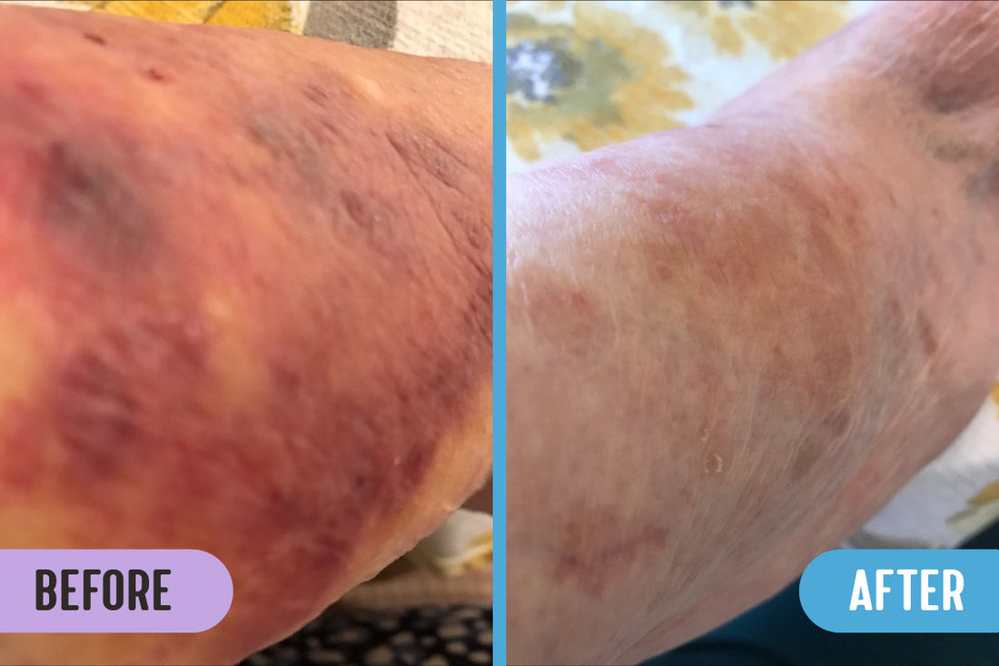 Before and after comparison of an elderly person's arm with visible red skin lesions in left photo versus much clearer skin in right 