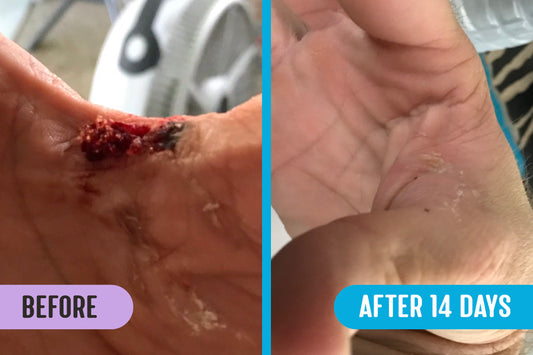 Before and after comparison of a significant wound with debris on a hand at lower thumb joint versus the same hand healed with minor scabbing and skin flakes