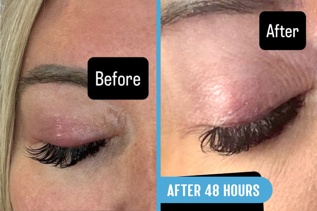 Before and after comparison of a stye on a woman's eyelid treated with Lavengel® for 48 hours, with reduced swelling and redness in after photo