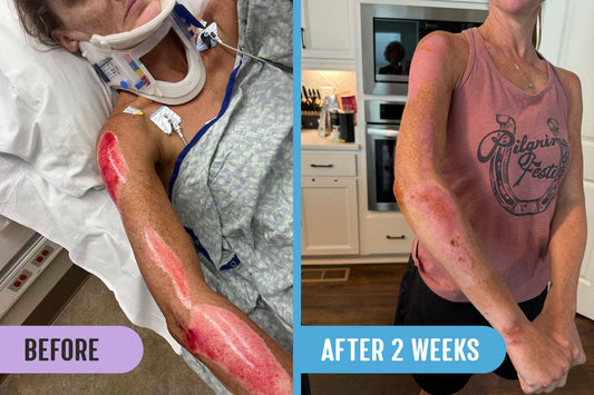 Before and after comparison; left photo: woman in hospital bed with severe road rash burns on right shoulder and arms; right photo: woman stands in kitchen, with burns showing remarkable recovery after two weeks of treatment with RadiQuell®