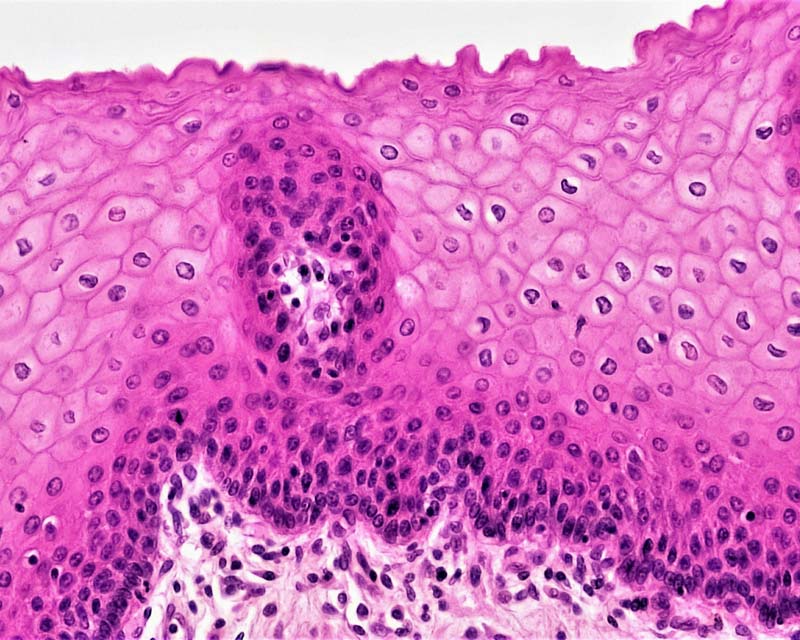 A close-up histological slide of stratified squamous epithelium, showing pink and purple stained cells with a central cluster of darker nuclei, seen at 200x magnification